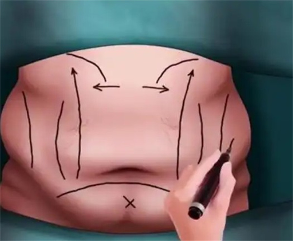 四川現(xiàn)代李獻和預約掛號戳這里！腹壁整形|手臂拉皮不用排隊輕松變美