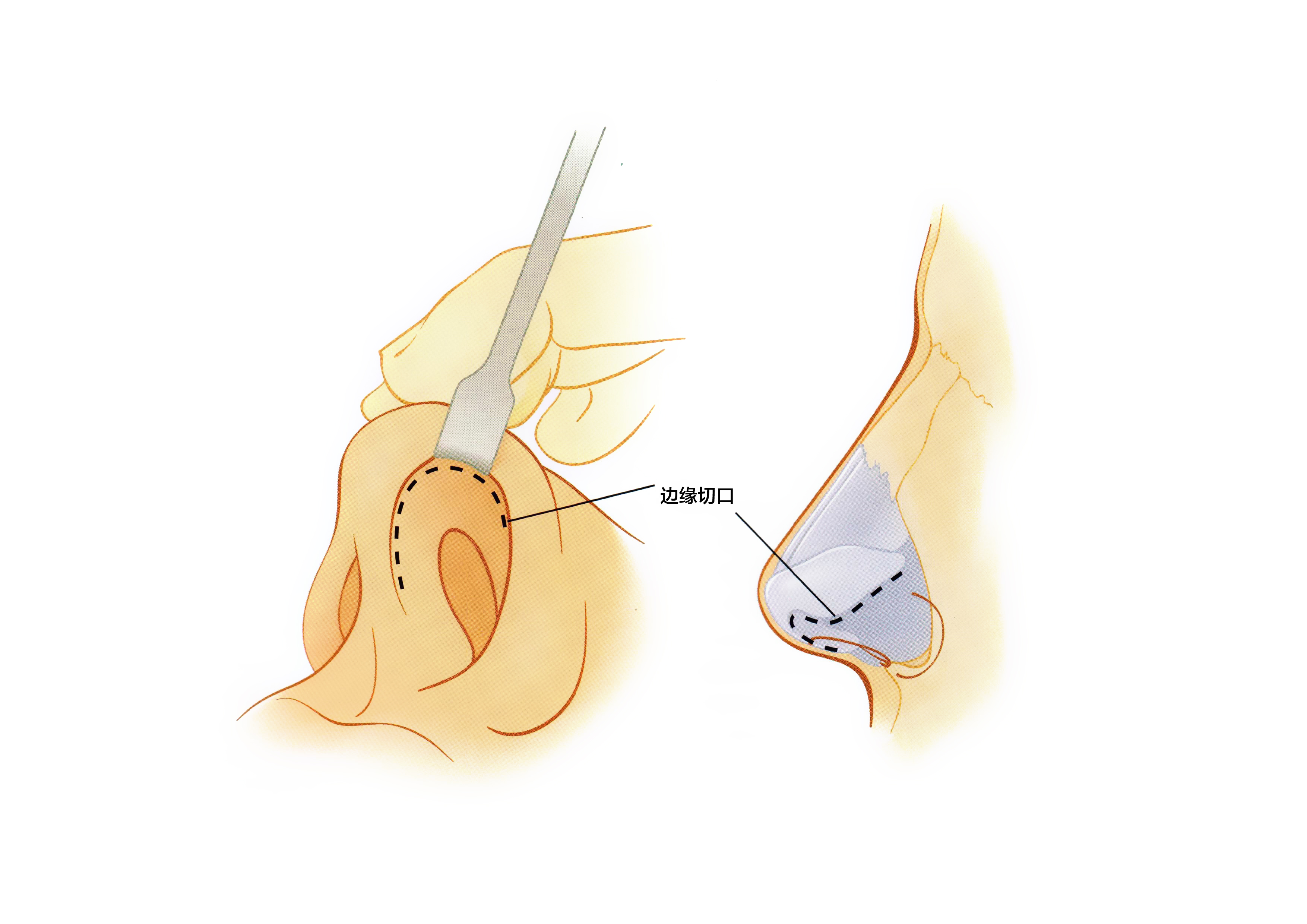 成都段燾和鄧東偉怎么選？西區(qū)醫(yī)院自然媽生感對(duì)上鏡網(wǎng)紅鼻這幾點(diǎn)要注意！