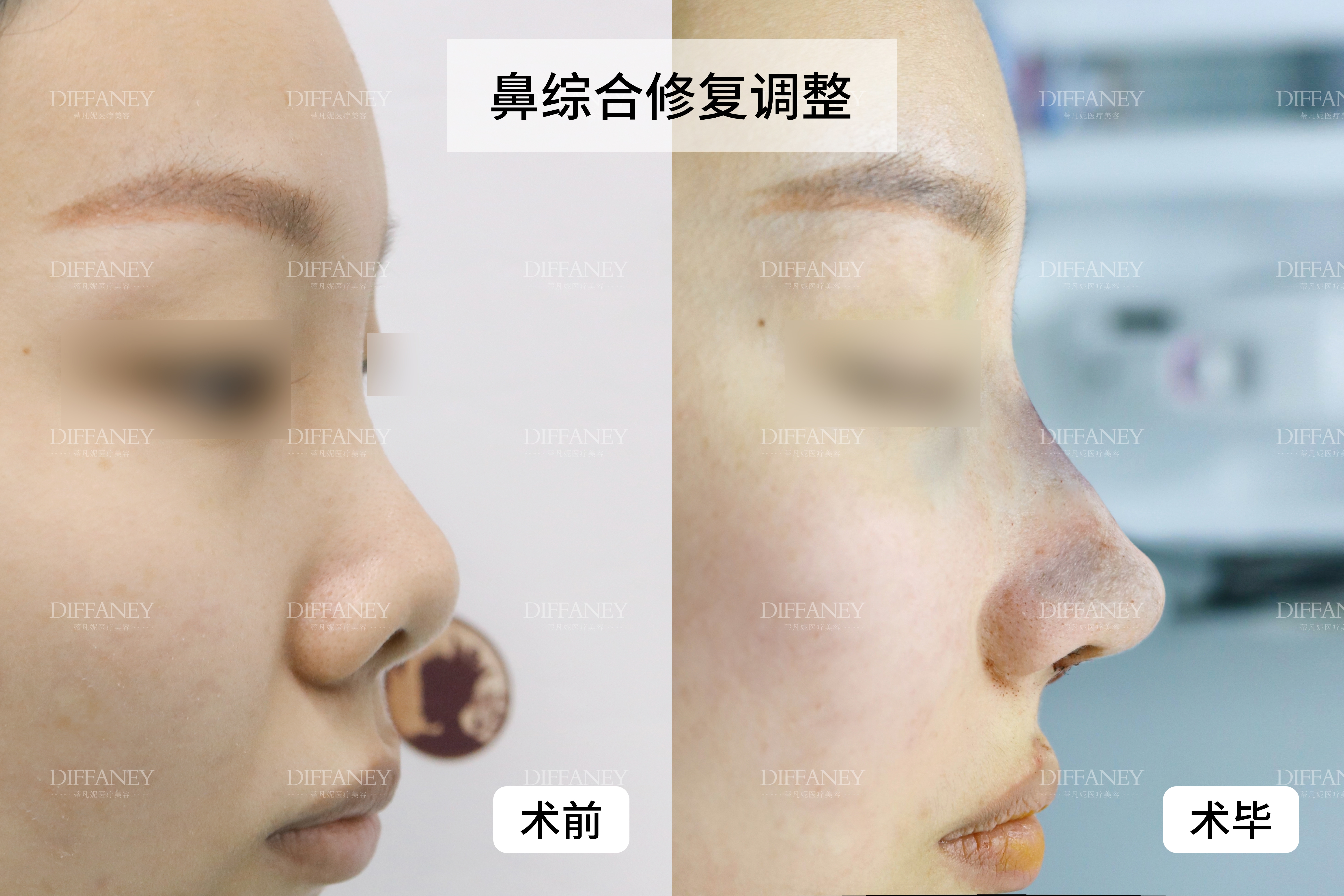 二、影響鄭永生醫(yī)生鼻骨磨骨手術(shù)費(fèi)用的因素