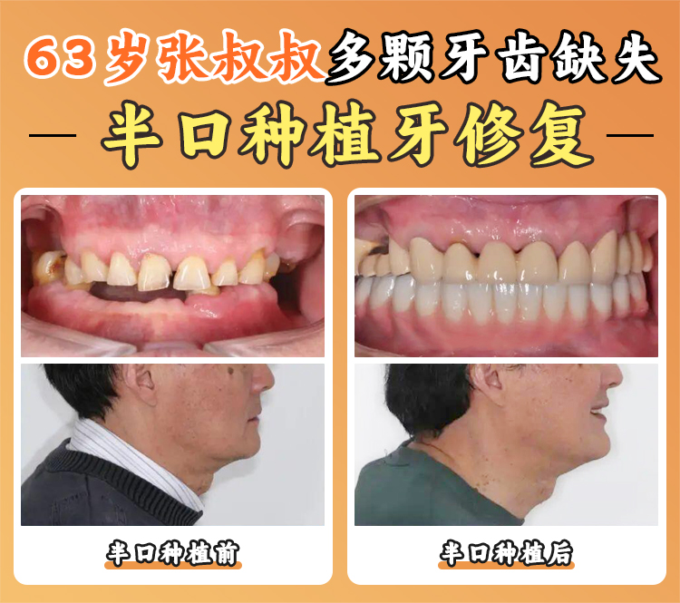 三、趙雪忠院長與種植牙技術特色