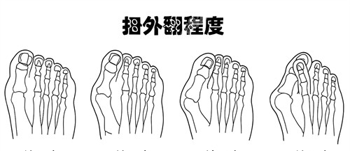 蘇敬達(dá)大腳骨手術(shù)貴不貴？12800元起的價格明細(xì)|修復(fù)周期|技術(shù)優(yōu)勢全解析