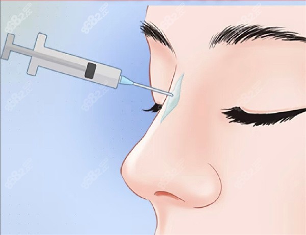 玻尿酸隆鼻 玻尿酸隆鼻