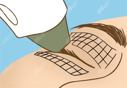 熱瑪吉眼部抗衰過程圖解