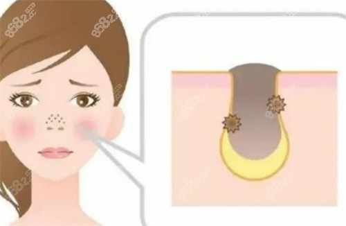 鼻子發(fā)炎 鼻子發(fā)炎