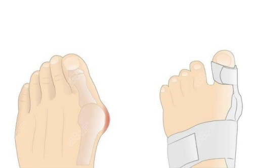 大腳骨矯正卡通圖