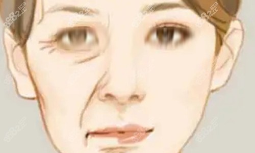 拉皮手術(shù)的對比動畫圖 拉皮手術(shù)的對比動畫圖