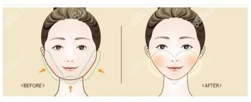 磨骨手術(shù)前后的區(qū)別 磨骨手術(shù)前后的區(qū)別