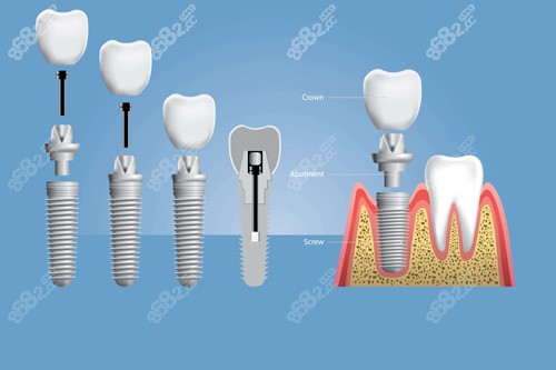 種植牙安裝示意圖