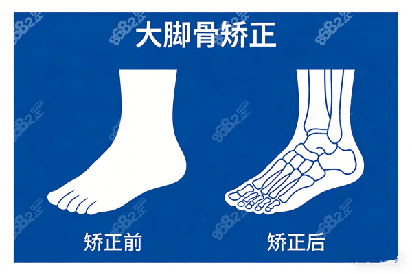 大腳骨矯正卡通圖一覽
