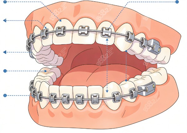 牙齒金屬矯正治療示意圖 牙齒金屬矯正治療示意圖