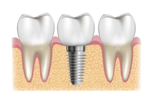 種植牙周圍健康牙