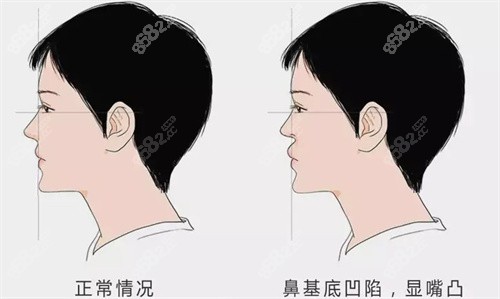 鼻基底凹陷填充 鼻基底凹陷填充