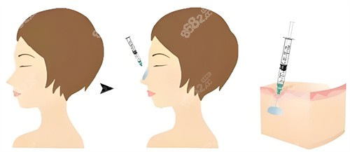 劉建軍贛州韓美做隆鼻手術費用明細？醫(yī)生擅長項目+醫(yī)院實力+具體價格