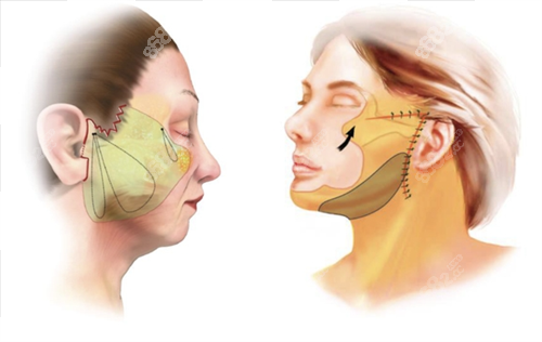 拉皮手術(shù)面部脂肪組織區(qū)域圈畫圖 拉皮手術(shù)面部脂肪組織區(qū)域圈畫圖