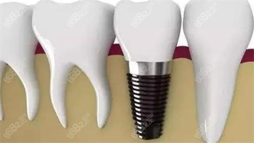 朔州哪家牙科種牙好？這三家醫(yī)院植體全，2980起價(jià)格透明