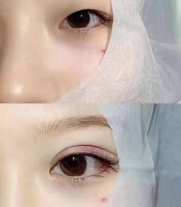 四、劉平眼部修復(fù)價格是多少？