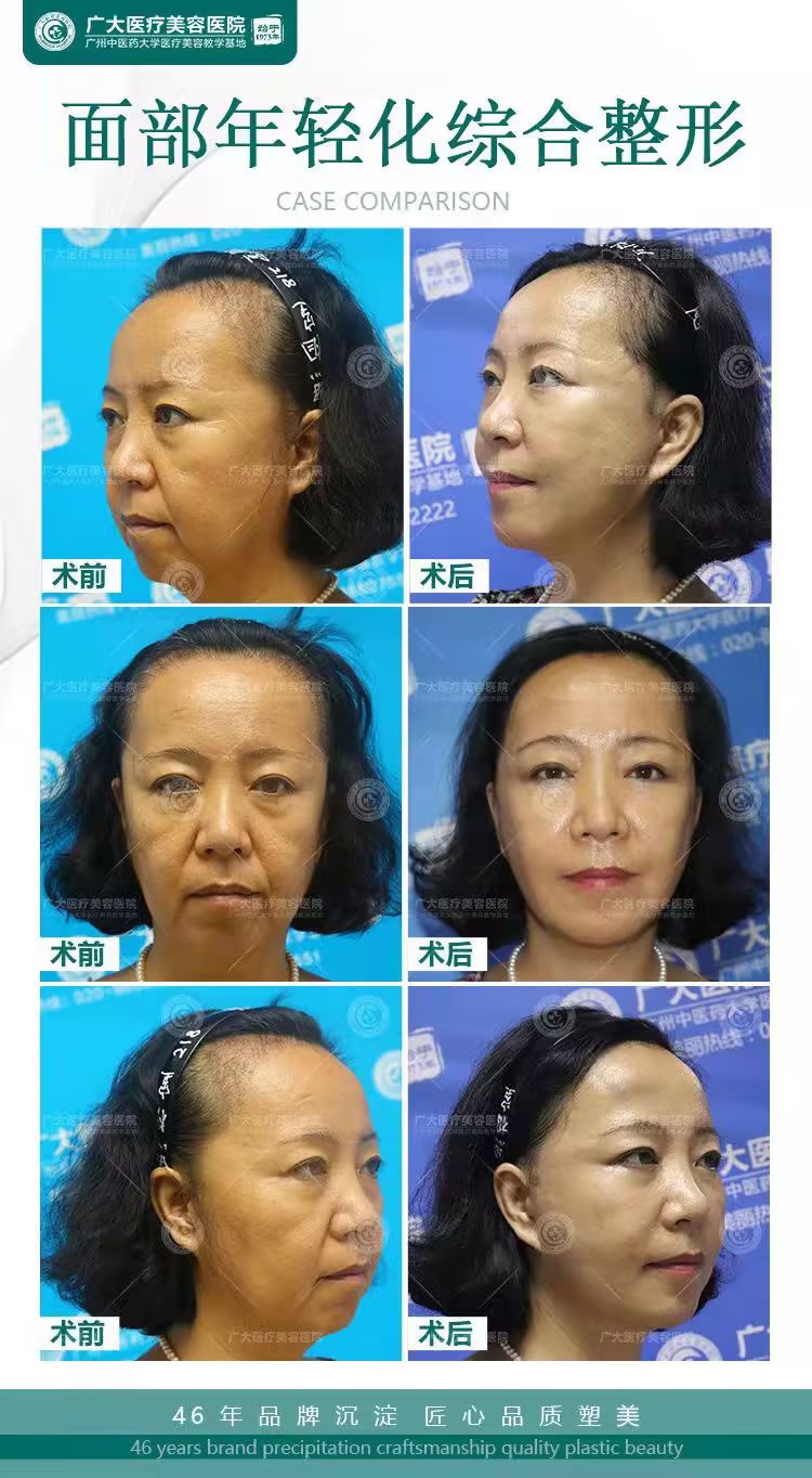 45 +歲求美者：術(shù)后狀態(tài)自然緊致