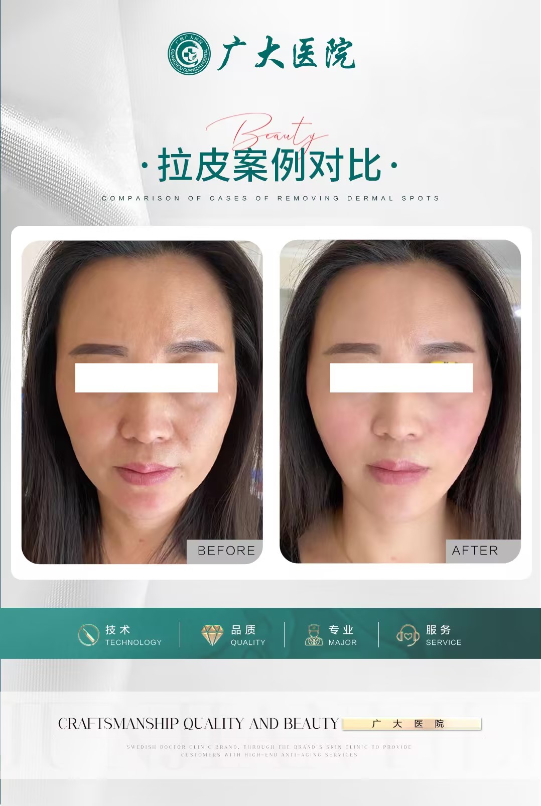 46 歲求美者：長期成效佳