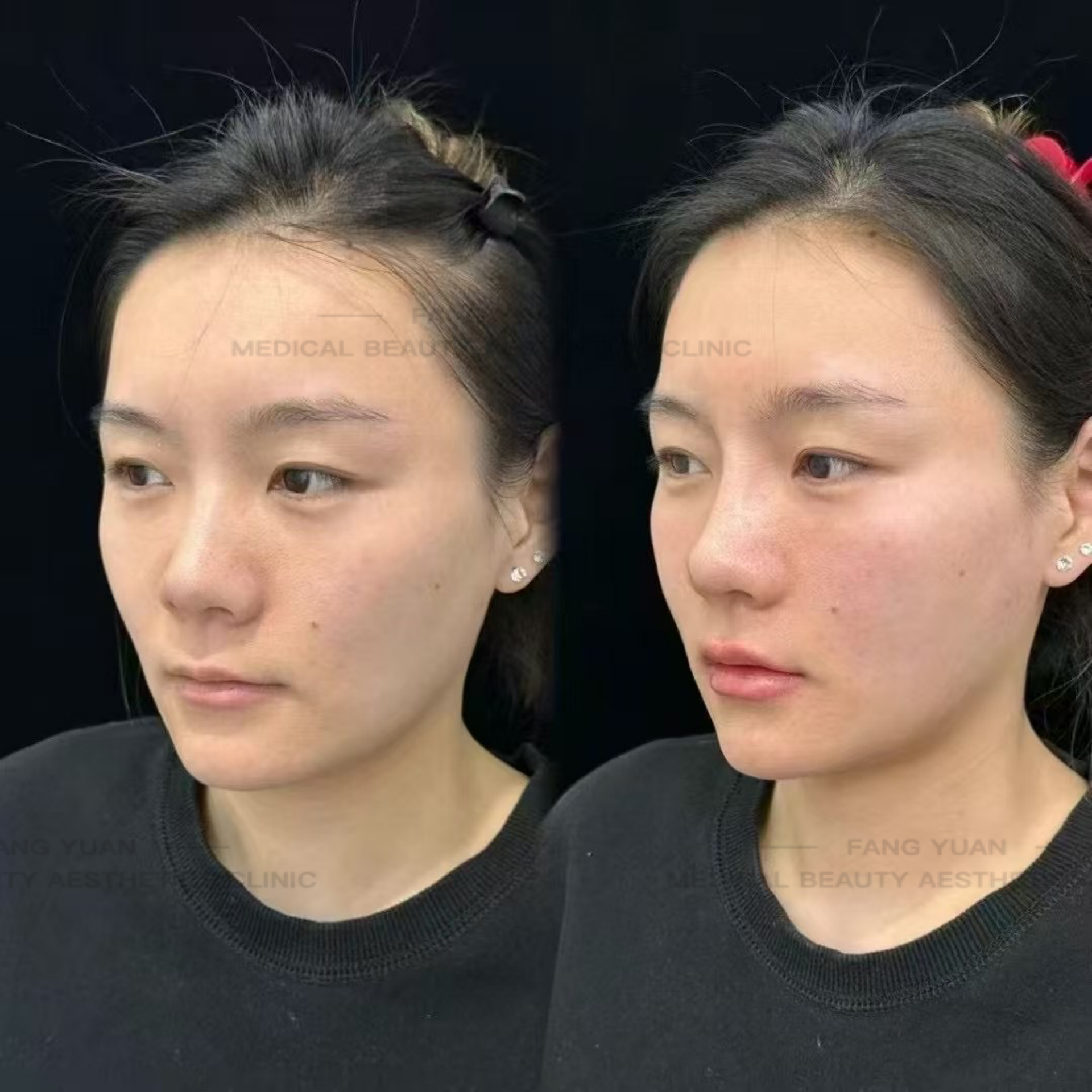 北京朝聚眼科醫(yī)院手術價格與優(yōu)勢