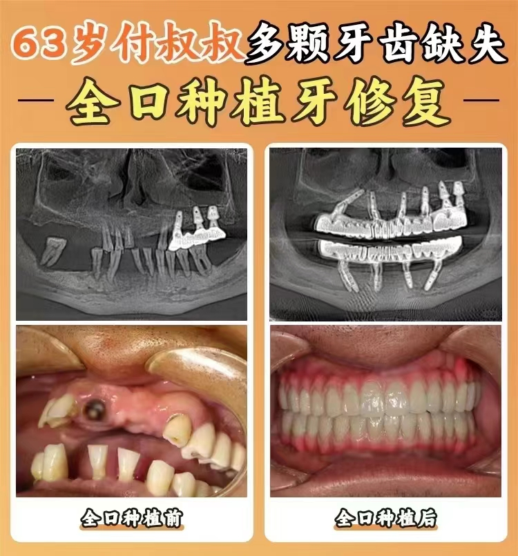 西安诺贝尔口腔是私立医院吗？民营口腔种植牙6380元起/正畸9725元起，杨晓萌医生亲诊
