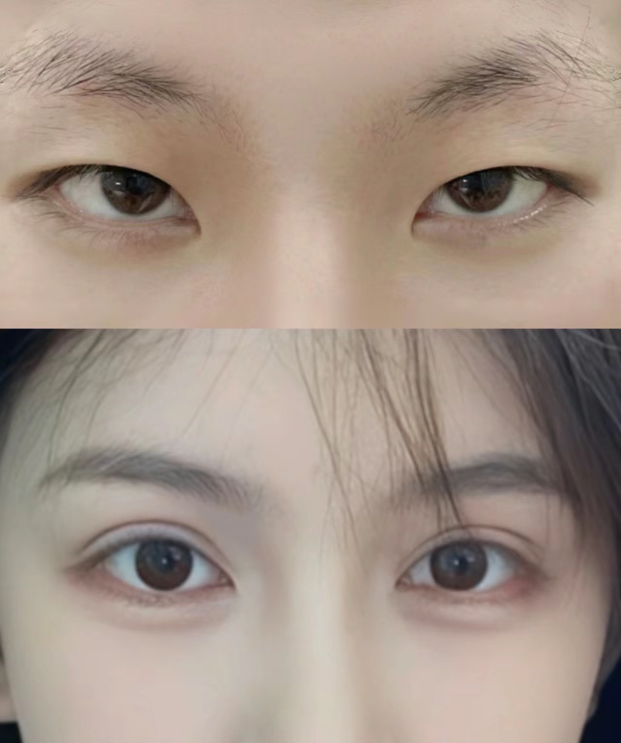 二、肉條眼、三眼皮怎么修？周瑜醫(yī)生的方法特別細！