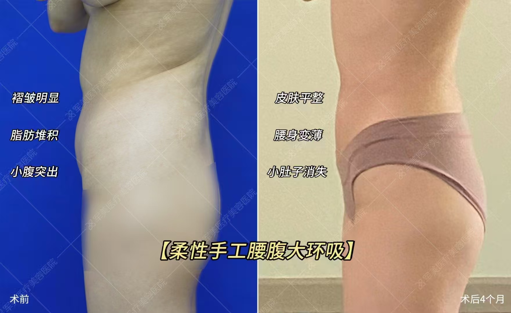 杭州哪家抽脂比較好？浙醫(yī)二院整形科具有影響力可靠