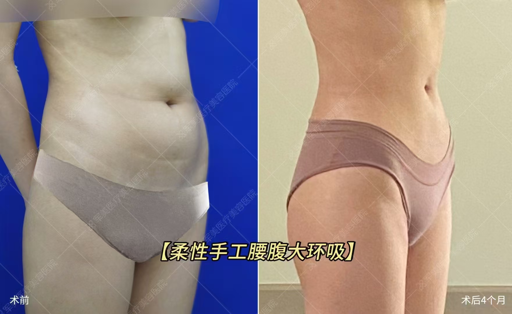 杭州哪家抽脂比較好？浙江省人民醫(yī)院整形外科經(jīng)驗(yàn)多