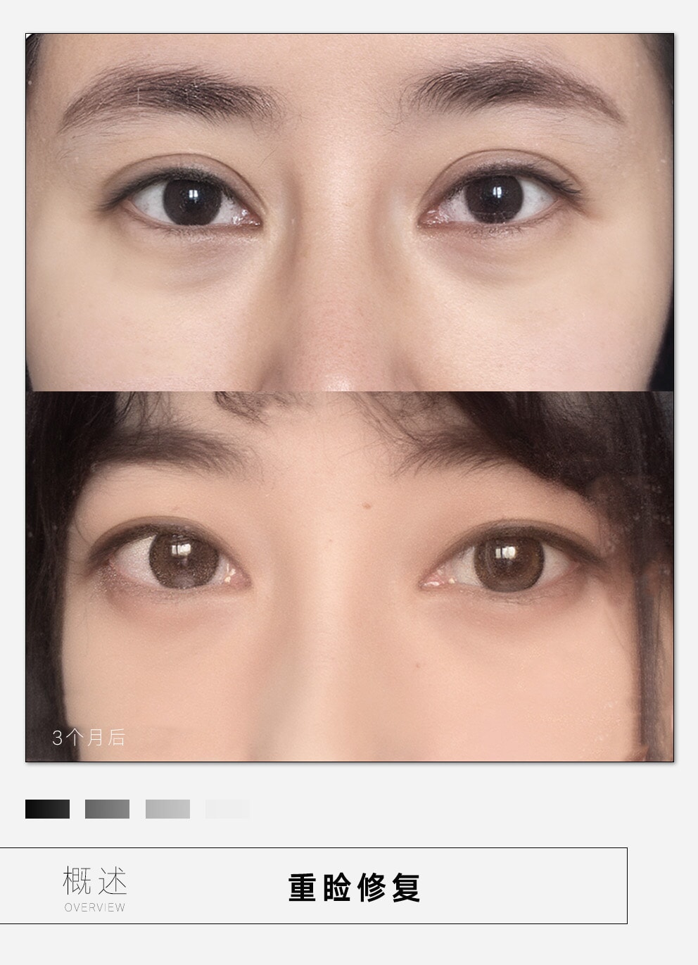 與其他臥蠶再造方法對比