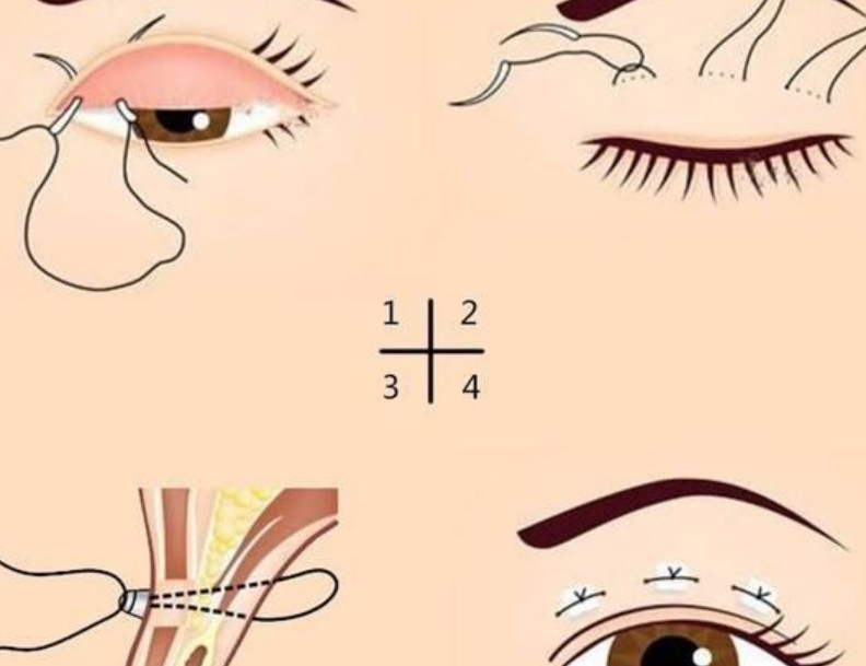 一、邵建川雙眼皮手術(shù)價(jià)格表2026新版：一份你看了就明白的收費(fèi)清單