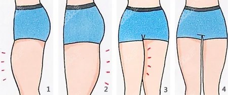 大腿吸脂卡通圖