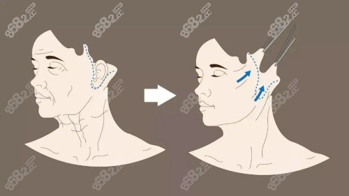拉皮器械都有什么网友揭秘北京十大拉皮大佬排名,北京公认前五的是穆宝安/杨大平/高亚东-上海聚慕医疗器械有限公司