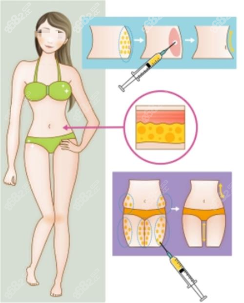 全身吸脂部位示意圖