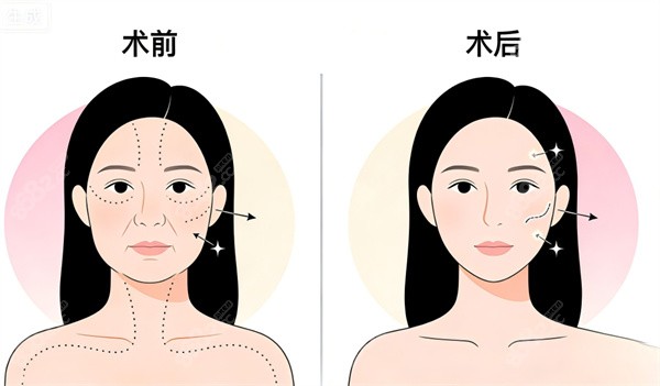 面部拉皮整形手术前后对比 面部拉皮整形手术前后对比
