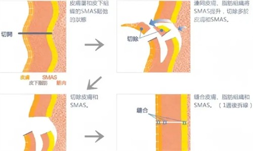 拉皮手术过程 拉皮手术过程