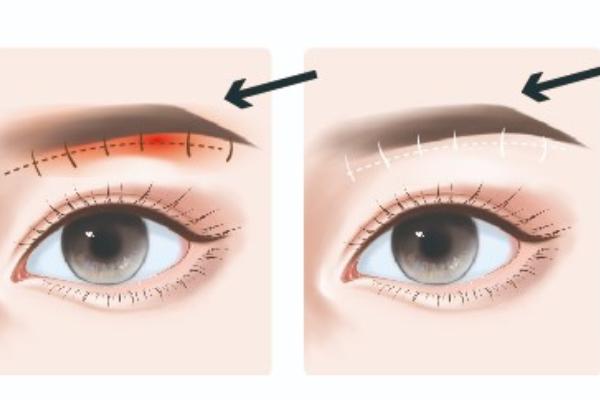 鄭州賈亮醫(yī)生修復(fù)雙眼皮怎么樣？亮眼整形口碑曝光！自然無痕風(fēng)格+高性價比成求美者首選