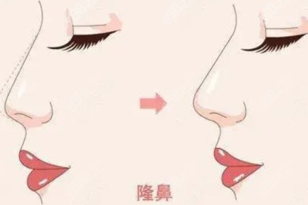 北京做鼻綜合誰做的自然靠譜，北京協(xié)和龍飛范飛劉彥軍實力上榜，術后自然不假臉