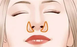 桂行軍鼻綜合做的怎么樣？自體軟骨榫卯支架技術(shù)，肋骨鼻與假體鼻綜合自然風(fēng)格真實案例測評