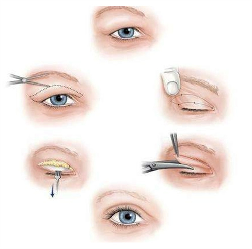 王楊醫(yī)生眼袋修復(fù)怎么樣？微創(chuàng)隱痕操作切口隱蔽，兼顧平整度與眼部動態(tài)，不破壞眼周原生形態(tài)