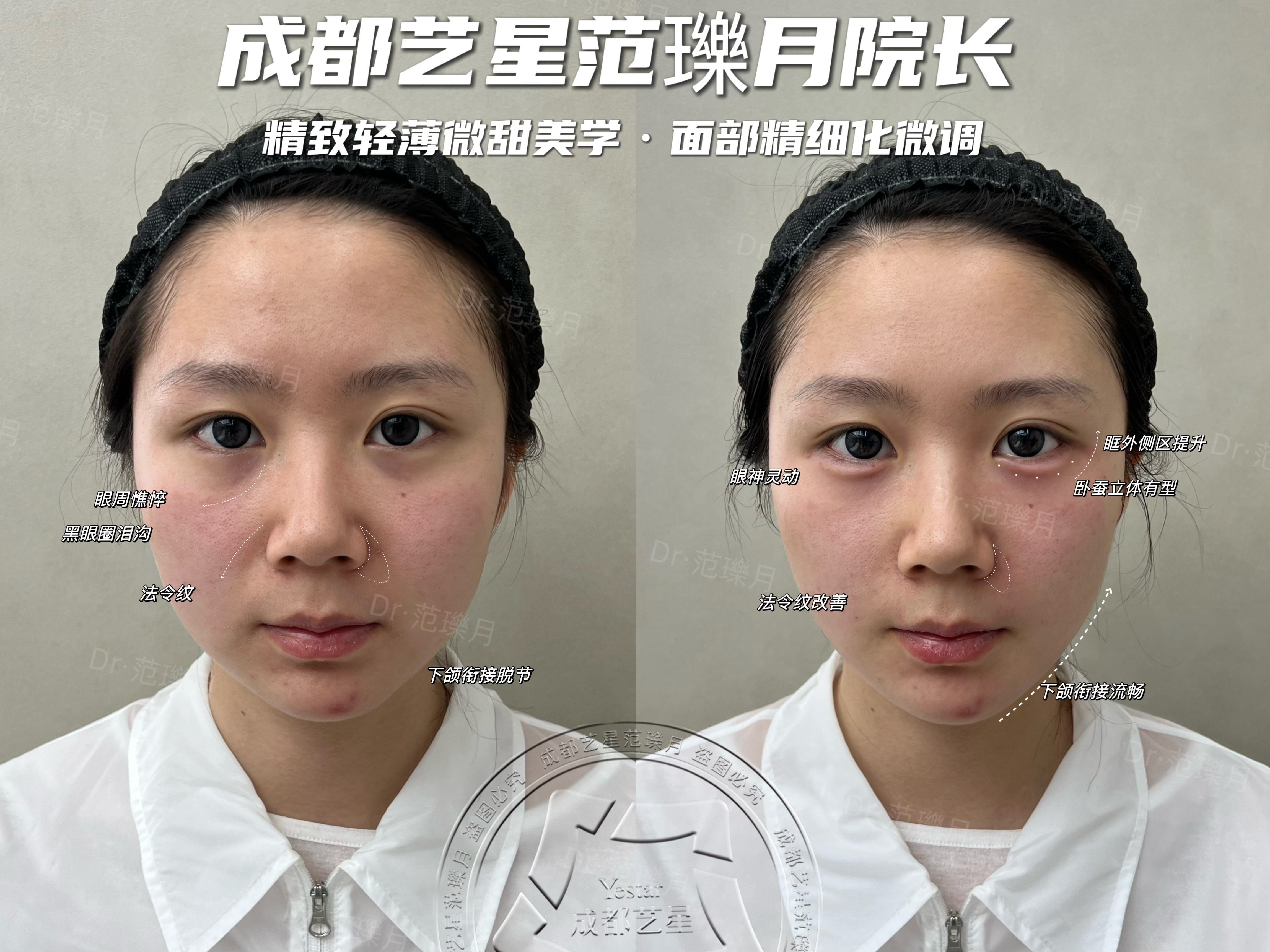 四、PST面部提升的臨床應(yīng)用m.sorencai.cn