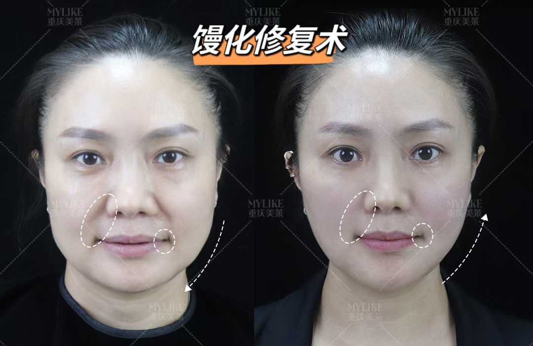 一、北京黎星醫(yī)生做修復(fù)技術(shù)實(shí)力揭秘