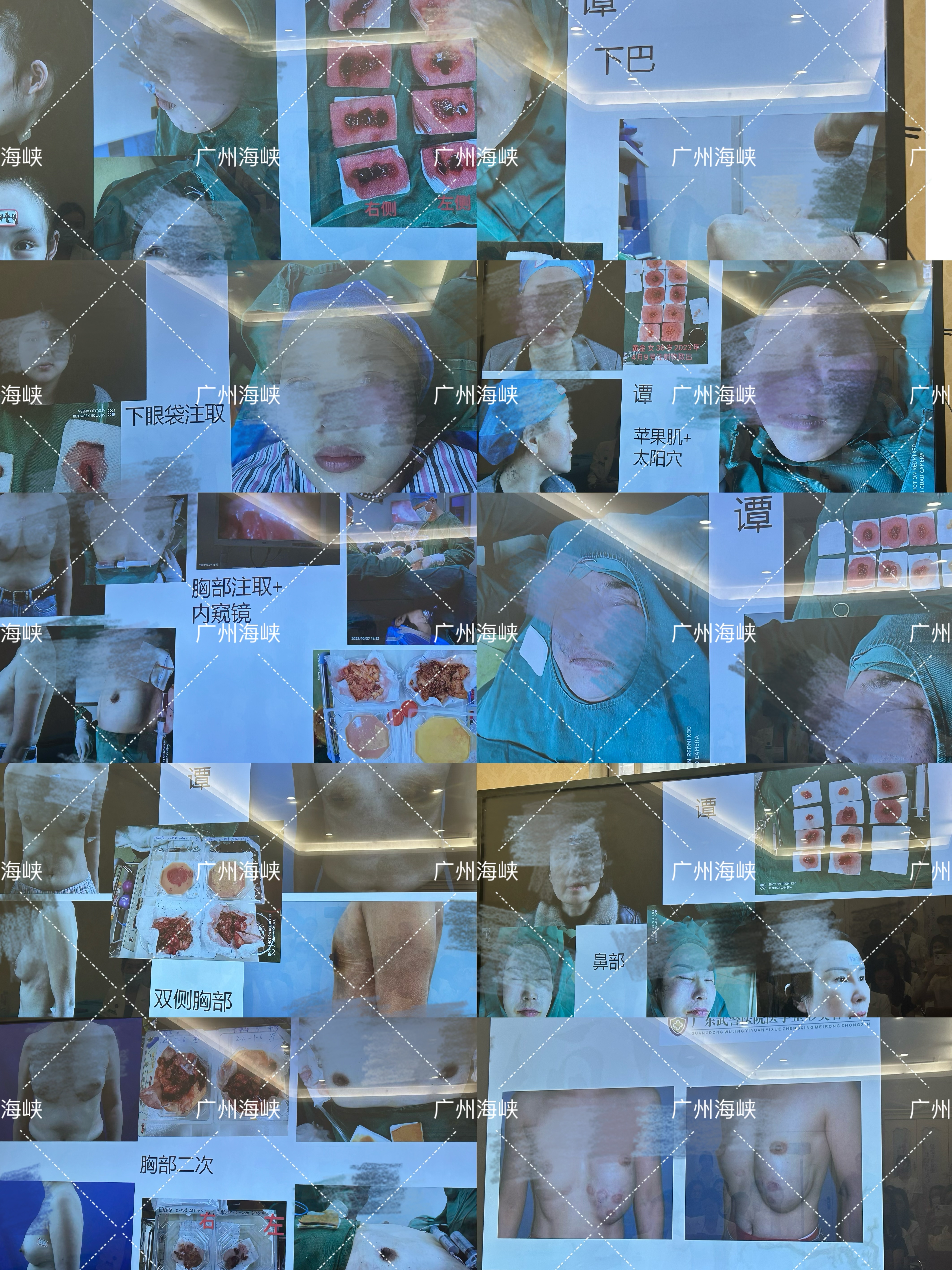 五、患者真實反饋：清奧干凈，術(shù)后修復快m.sorencai.cn