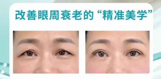 三、提眉手術(shù)相關(guān)延伸問題解答