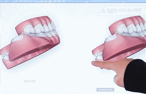隱形牙齒矯正3D模型展示