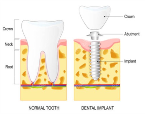 種植牙和正常牙齒對(duì)比圖