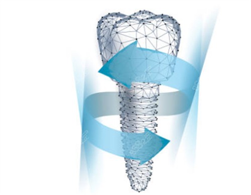 種植牙模型卡通圖