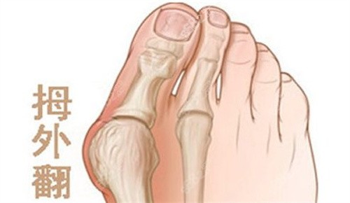 拇外翻