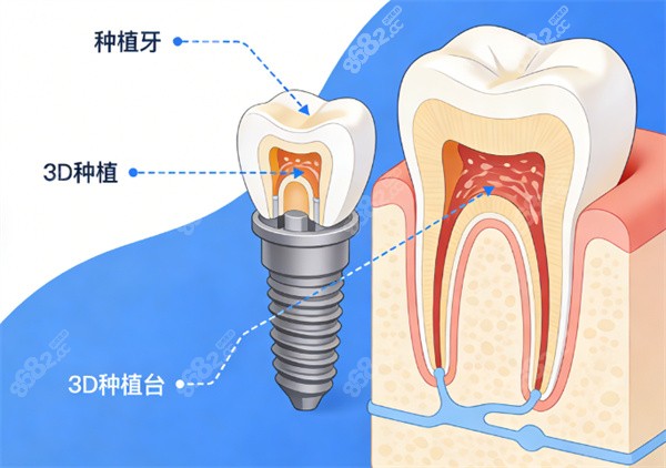 蕪湖市種植牙多少錢(qián)一顆？2026年超詳細(xì)價(jià)格表解析，瑞士種牙9800起