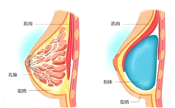 隆胸假體放置位置