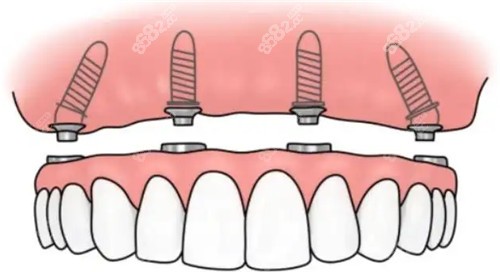 半固定種植牙卡通圖