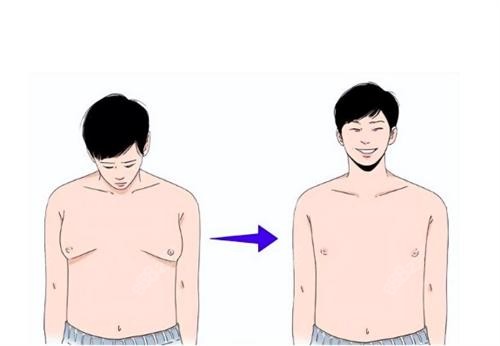 男性乳房肥大下垂